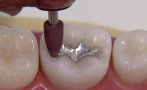 Shofu Amalgam Polishing Kit - FG/CA - Image 3