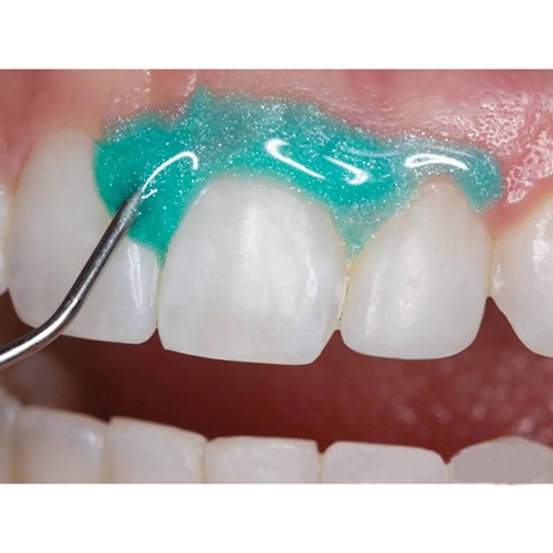 Prime Dental Gingisafe Light Cure Gingival Barrier Kit - Image 2