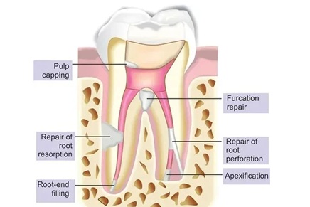 Maarc Ceraset MTA Putty Bioceramic for Root & Pulp Treatment - Image 3