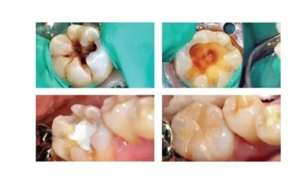 Maarc Ceraset MTA Putty Bioceramic for Root & Pulp Treatment - Image 2