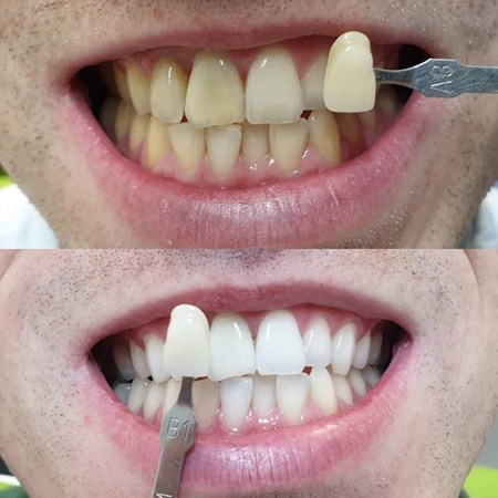 Maarc Blitz White Bleaching Kit 35 HP Based In-Office Tooth Whitening Kit - Image 3