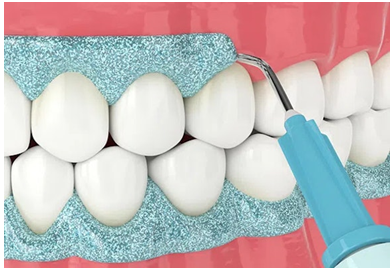 Maarc Blitz White Bleaching Kit 35 HP Based In-Office Tooth Whitening Kit - Image 2