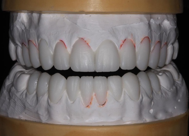 Maarc Dental Mock Up Wax - Image 3