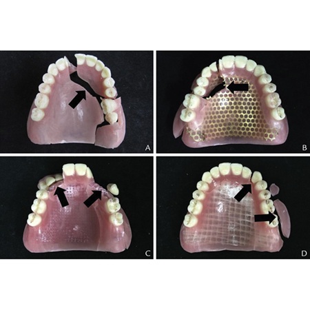Maarc Reinforcement Mesh Acrylic Denture Bases For Enhanced Durability - Image 4