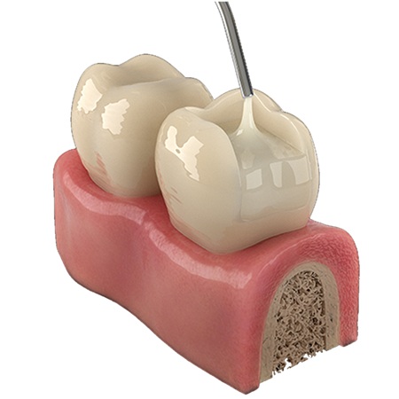 Prime Dental Restorite Bulk Fill (Flowable) - Universal Shade - Image 4