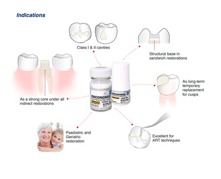 Shofu Zirconomer Improved Reinforced Glass Ionomer - Image 3